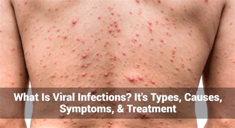 the type of viral infection figgerits|Viral Infection: Types, Symptoms, Causes, Diagnosis, Treatment .